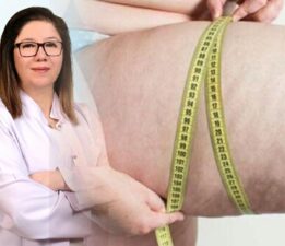 Prof. Dr. Arslan, “Kol ve bacaklarınız çabuk morarıyorsa dikkat!”
