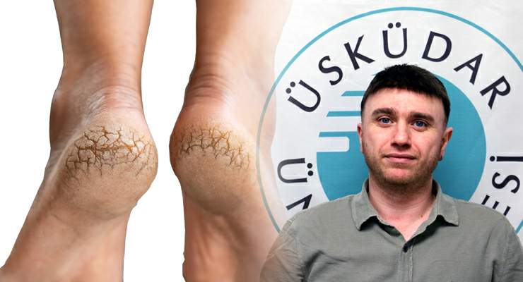 Topuk çatlağını göz ardı etmeyin, enfeksiyonlara davetiye çıkarıyor!